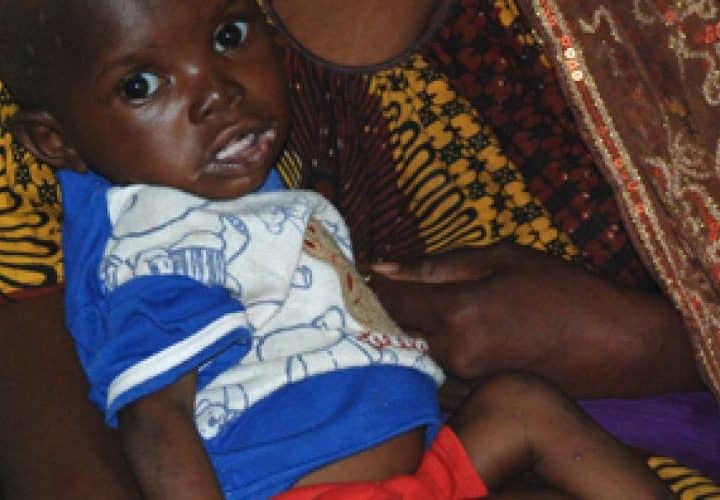 Enfant souffrant de malnutrition au Mali, illustrant la crise sanitaire